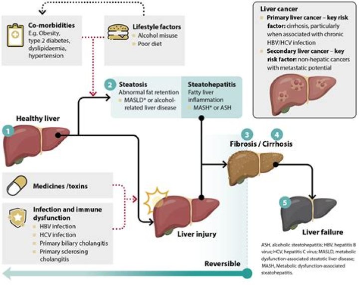 Does PCOS affect the liver?