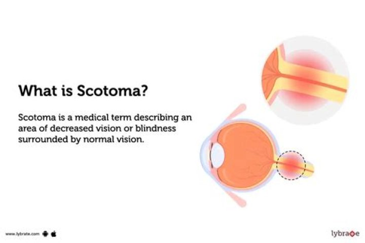 What is a ring scotoma?