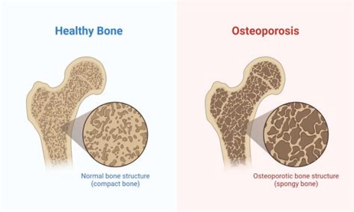 What is the prognosis for osteoporosis?
